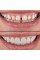 Накладка на зуби Tooth Cover вініри Perfect Smile
