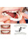 Знімні вініри для зубів верхньої щелепи з кейсом Veneers Smile